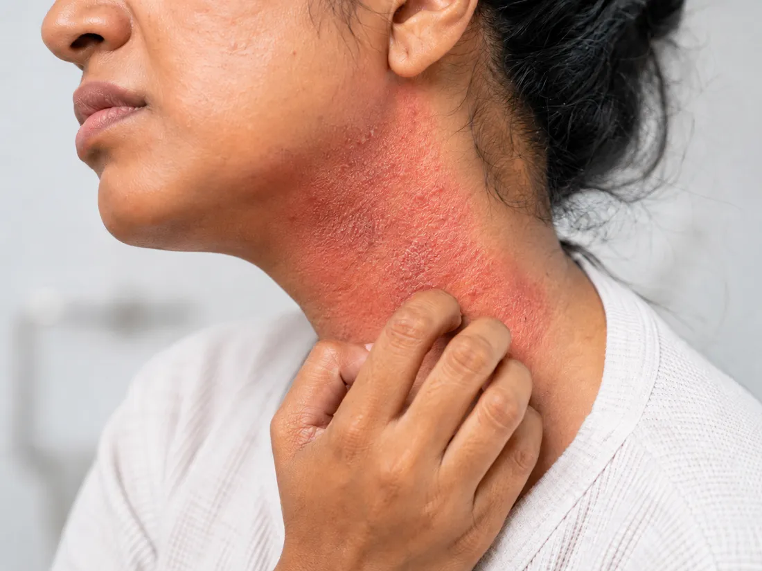 Eczema on neck with irritation and itching