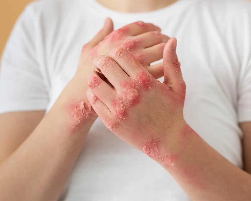 Severe eczema flare-up on both hands