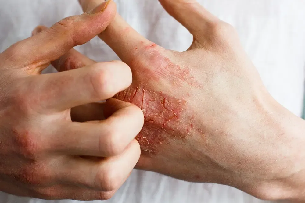 Dry, inflamed eczema patch on hand