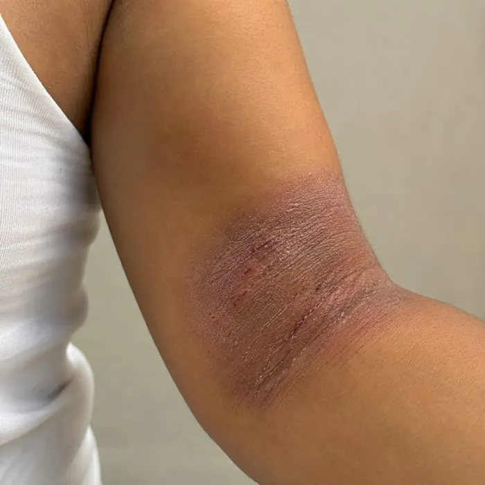 Elbows before homeopathic eczema treatment