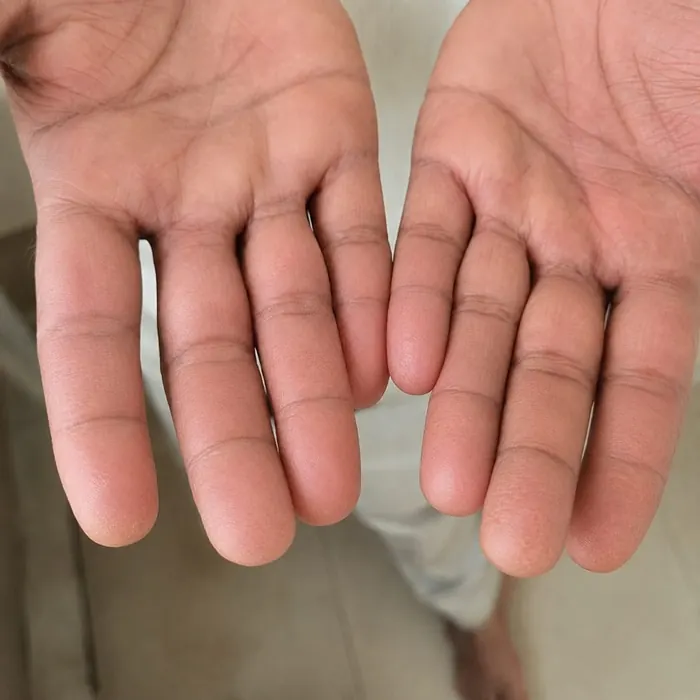 Fingers after homeopathic eczema treatment