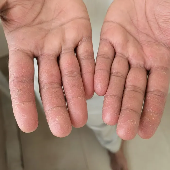 Fingers before homeopathic eczema treatment