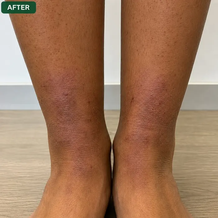 Lower legs & ankles after homeopathic eczema treatment