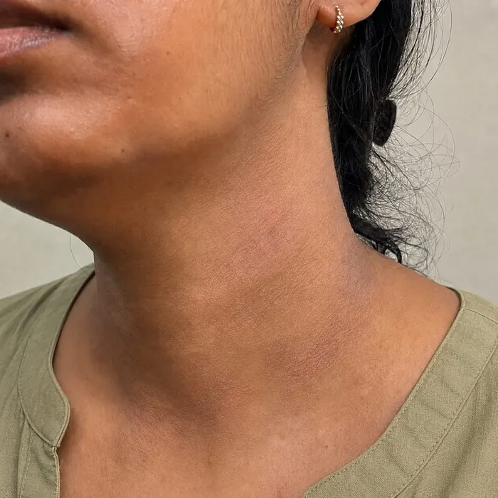 Neck after homeopathic eczema treatment