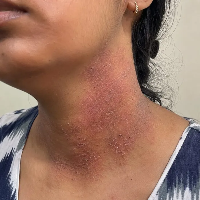 Neck before homeopathic eczema treatment