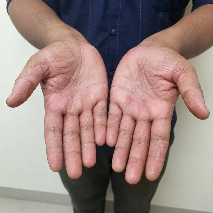 Palms before homeopathic eczema treatment